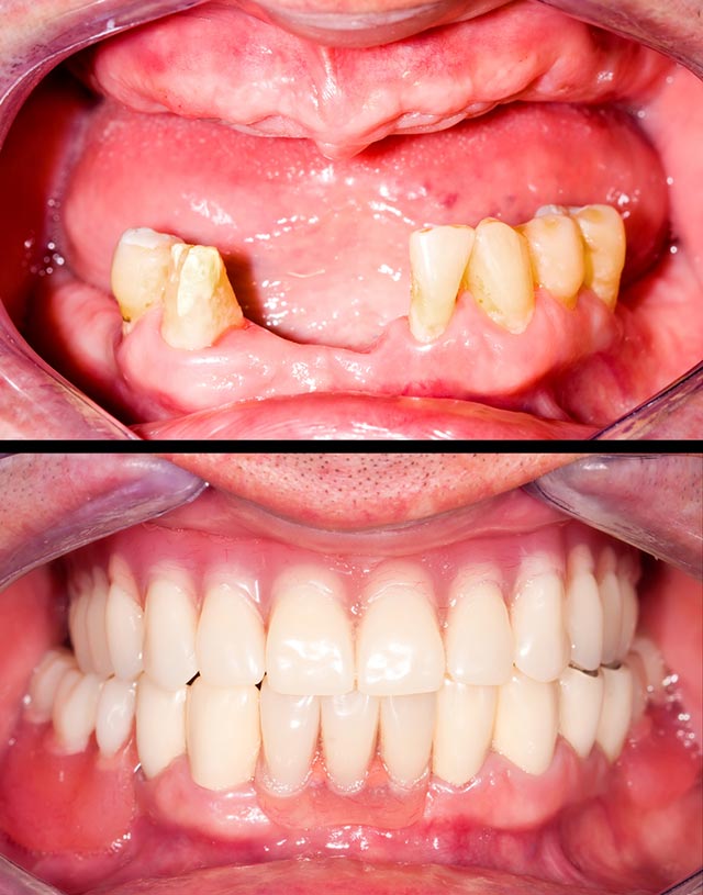 Before and After - Implant