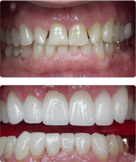 Before and After - Veneer