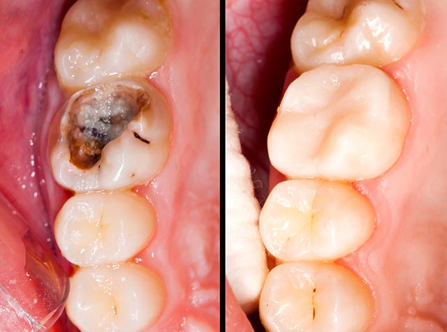 Before and After - White Fillings