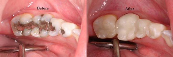 Before and After - White Fillings