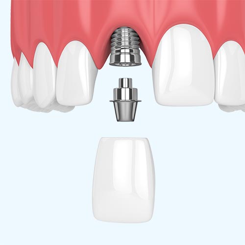 Dental Implants