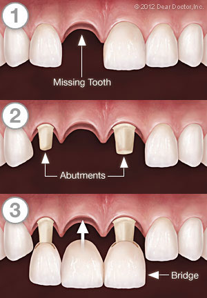 Dr. Joseph Spina, Dental Bridge