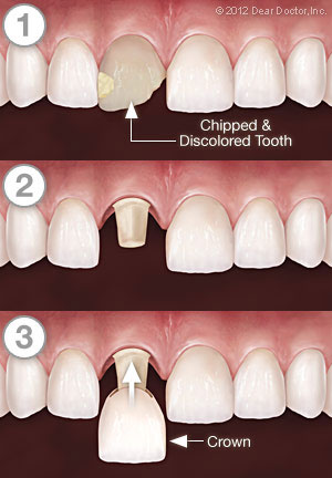 Dr. Joseph Spina, Dental Crown / Dental Cap