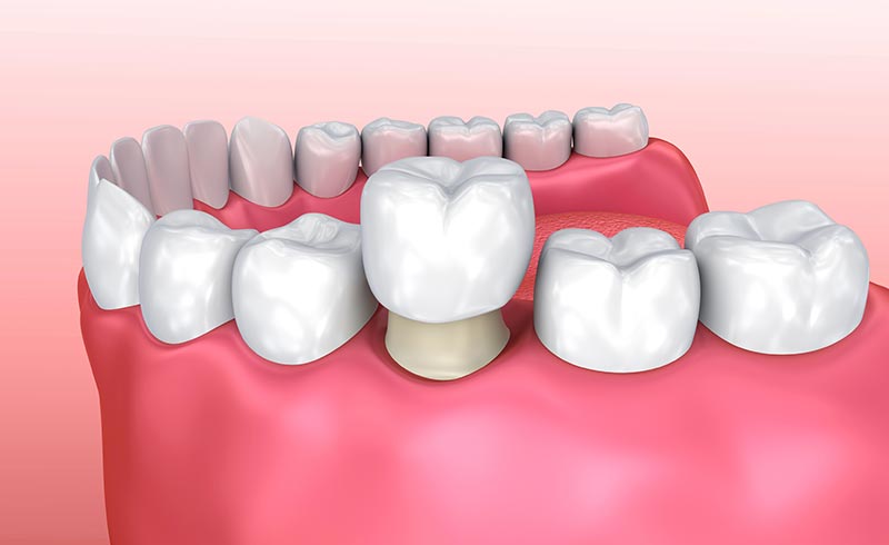 Dr. Joseph Spina, Dental Crown / Dental Cap