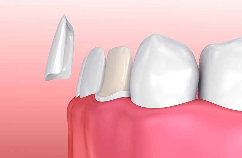 Dr. Joseph Spina - Dental Veneers