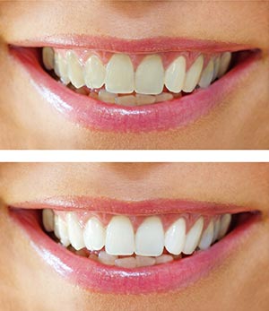 Dr. Joseph Spina, Teeth Whitening