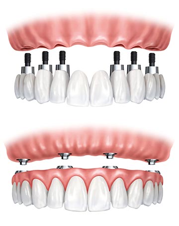 Dr. Joseph Spina - Permanent Replacement for all Teeth, Dental Implants