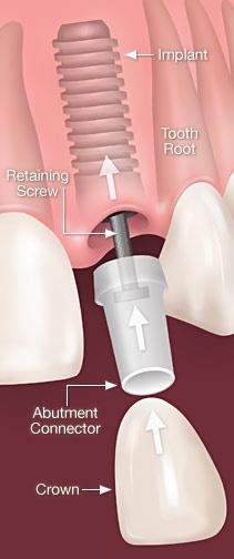 Dr. Joseph Spina - Dental Implants
