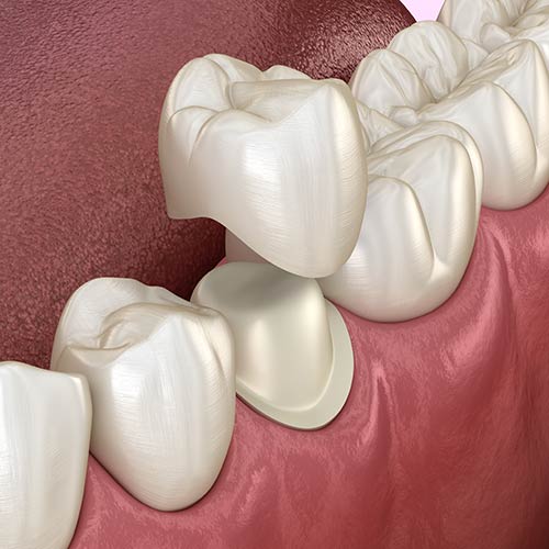 Dental Crowns & Bridges