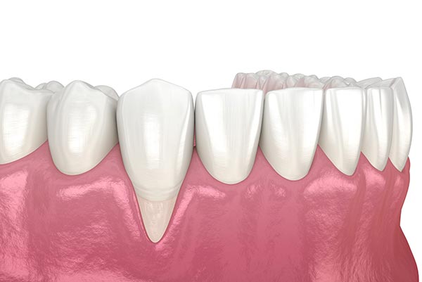 Dr. Joseph Spina, Dental Checkups, Gum Recession